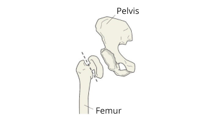 Hip Joint with arthritis
