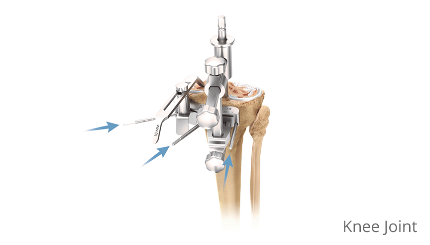 Knee Replacement Surgery