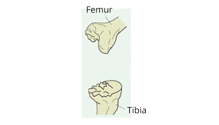 Knee Joint with arthritis