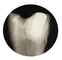 Bone-ingrowth-into-tesera-trabecular-technology-1.png